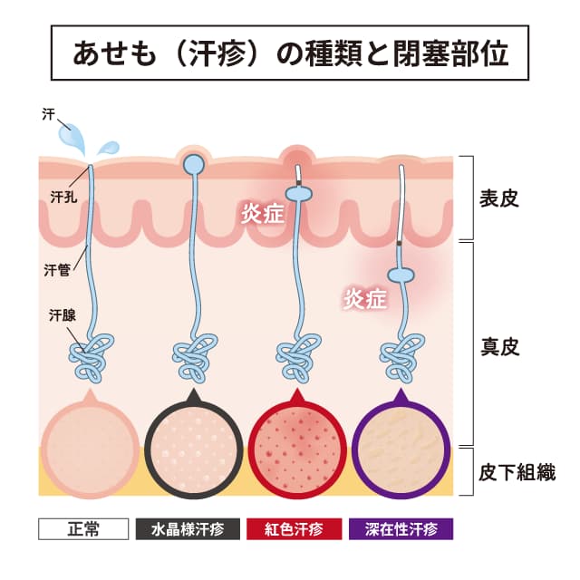 水晶様汗疹・紅色汗疹・深在性汗疹それぞれの汗管の閉塞部位を示した図