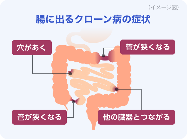 腸にあるクローン病の症状