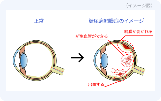 糖尿病による網膜症の兆候は他にもありますか?