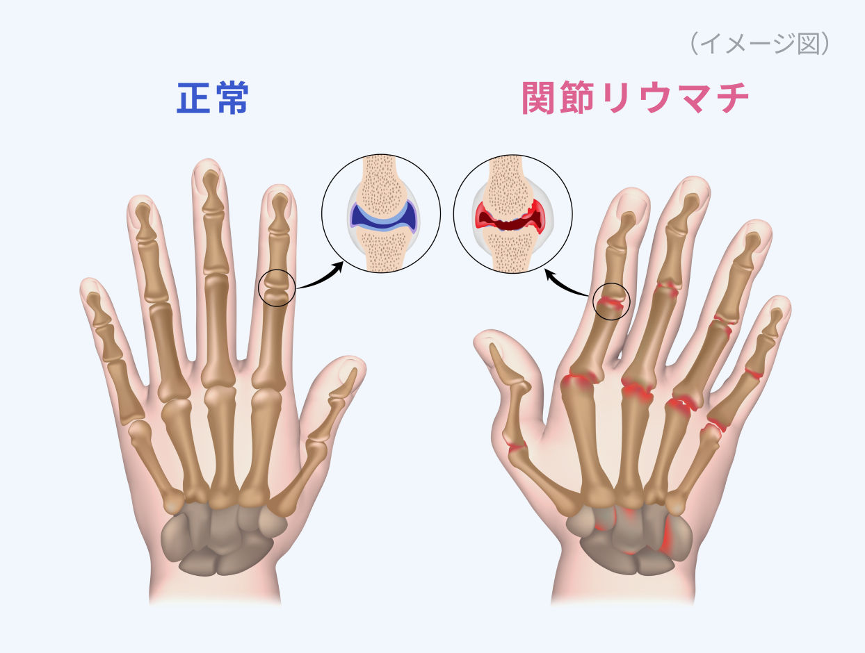 回文性リウマチの症状