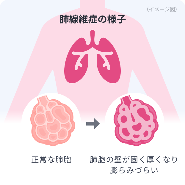 肺線維症・間質性肺炎」とあなたの症状との関連性をAIで無料チェック