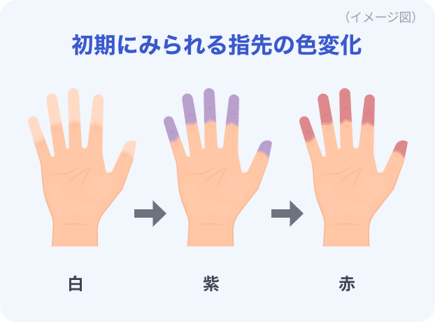 強皮症の初期にみられる指先の色変化のイメージ