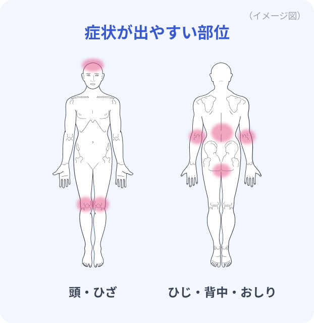 乾癬の好発部位とイラスト